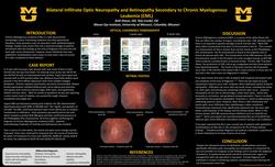 Bilateral Infiltrate Optic Neuropathy and Retinopathy Secondary to Chronic Myelogenous Leukemia (CML)